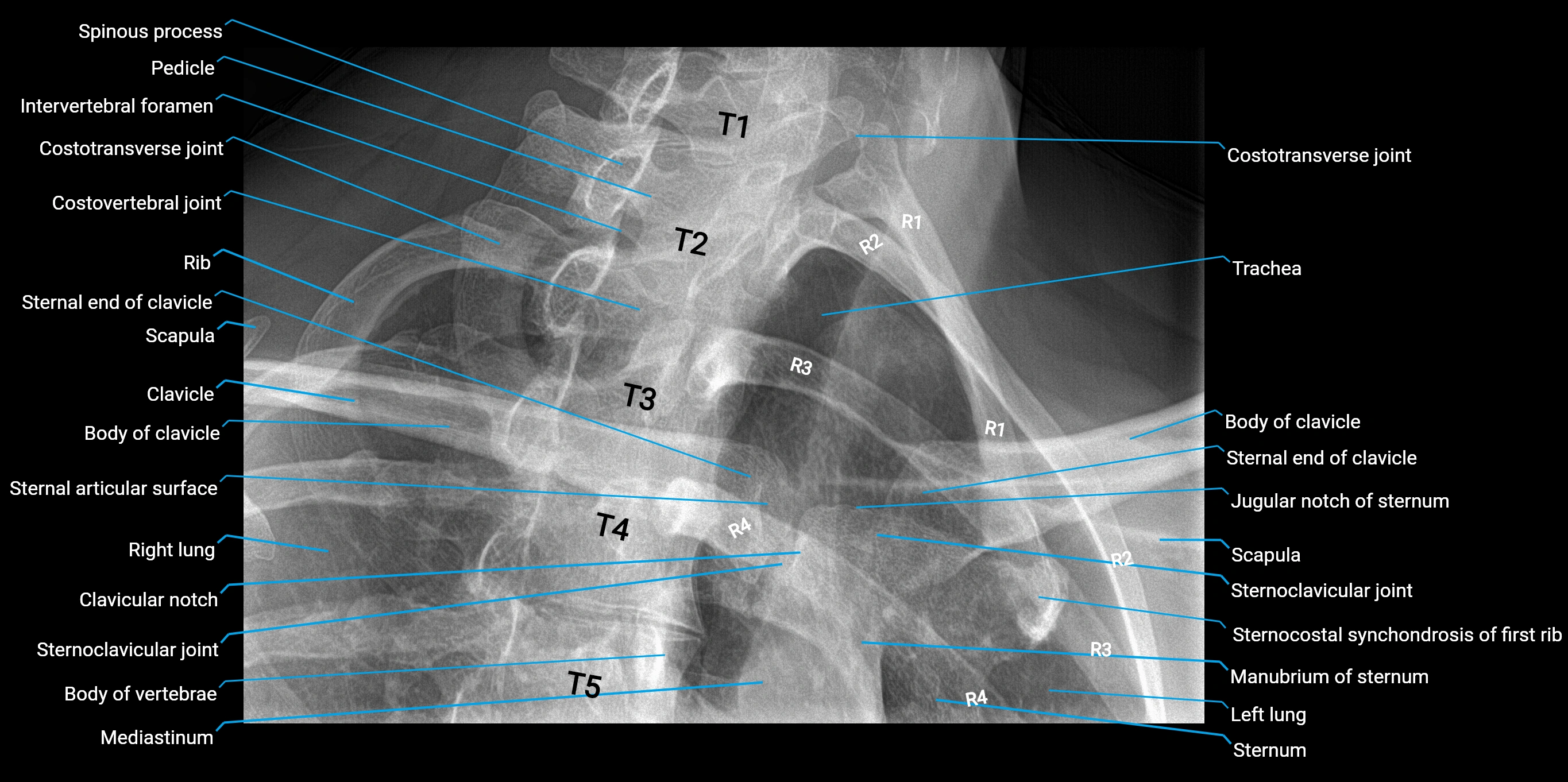 Sternoclavicular joint pa left oblique x ray  anatomy labelled image-img-00000-00000.webp